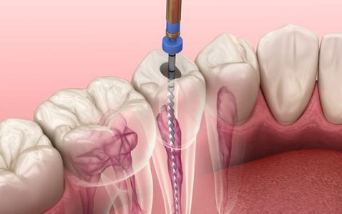 Endodoncia en Talcahuano